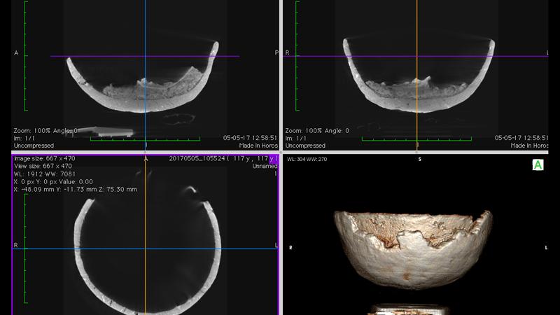 Vistas de la reconstrucción multiplanar  (3D MPR), y reconstrucción de volumen (3D VR). Operación CBCT Odontox , Leiva, V. Reconstrucciones Archivo CNCR, Correa, C.  2017 